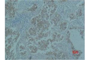 Immunohistochemistry (IHC) analysis of paraffin-embedded Human Lung Carcicnoma using Catenin-beta Monoclonal Antibody.