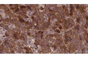 ABIN6277306 at 1/100 staining Human liver cancer tissue by IHC-P. (APLP1 anticorps  (Internal Region))