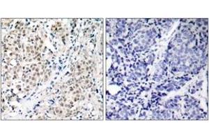 Immunohistochemistry analysis of paraffin-embedded human breast carcinoma tissue, using MYC (Ab-358) Antibody. (c-MYC anticorps  (AA 325-374))