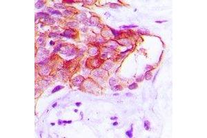 Immunohistochemical analysis of CADM2 staining in human prostate cancer formalin fixed paraffin embedded tissue section. (CADM2 anticorps)