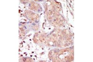 Formalin-fixed and paraffin-embedded human cancer tissue reacted with the primary antibody, which was peroxidase-conjugated to the secondary antibody, followed by DAB staining.