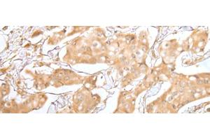 Immunohistochemistry of paraffin-embedded Human breast cancer tissue using GRAP Polyclonal Antibody at dilution of 1:40(x200) (GRAP anticorps)