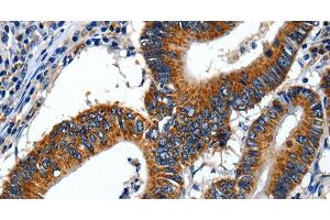 Immunohistochemistry of paraffin-embedded Human colon cancer using LAMA1 Polyclonal Antibody at dilution of 1:70 (Laminin alpha 1 anticorps)