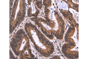 Immunohistochemistry of Human cervical cancer using MSH4 Polyclonal Antibody at dilution of 1:50 (MSH4 anticorps)