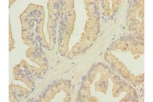 Immunohistochemistry of paraffin-embedded human prostate cancer using ABIN7165562 at dilution of 1:100 (FAM78A anticorps  (AA 21-283))