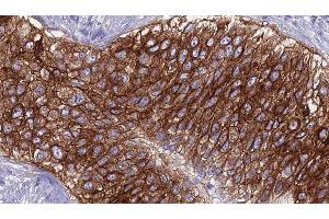 ABIN6275913 at 1/100 staining Human urothelial cancer tissue by IHC-P. (Adenosine A2a Receptor anticorps  (Internal Region))