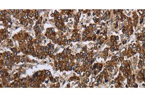 Immunohistochemistry of paraffin-embedded Human liver cancer using PPP1R13L Polyclonal Antibody at dilution of 1:30 (PPP1R13L anticorps)