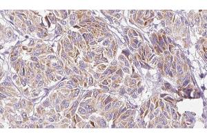 ABIN6277153 at 1/100 staining Human Melanoma tissue by IHC-P. (IL-10 anticorps  (Internal Region))