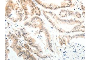 The image on the left is immunohistochemistry of paraffin-embedded Human colon cancer tissue using ABIN7189608(ABL2 Antibody) at dilution 1/25, on the right is treated with synthetic peptide. (ABL2 anticorps)