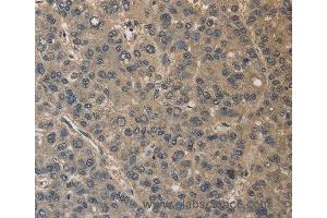 Immunohistochemistry of Human liver cancer using DRG1 Polyclonal Antibody at dilution of 1:30 (DRG1 anticorps)