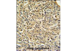 Merlin Antibody IHC analysis in formalin fixed and paraffin embedded human lung carcinoma followed by peroxidase conjugation of the secondary antibody and DAB staining. (Merlin anticorps  (N-Term))