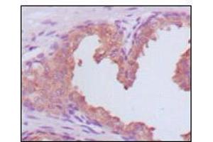 Immunohistochemical analysis of paraffin-embedded human prostate carcinoma tissues, showing cytoplasmic localization using KLK3 mouse mAb with DAB staining. (Prostate Specific Antigen anticorps  (AA 26-251))