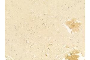 ABIN6261919 and ABIN6278467 at 1/100 staining human glioblastoma by IHC-P. (GCLC anticorps  (N-Term))