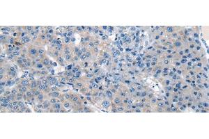 Immunohistochemistry of paraffin-embedded Human liver cancer tissue using CITED4 Polyclonal Antibody at dilution of 1:65(x200) (CITED4 anticorps)