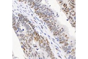 Immunohistochemistry analysis of paraffin-embedded human colon cancer using ADRA1B (ABIN7072974) at dilution of 1: 1200 (ADRA1B anticorps)