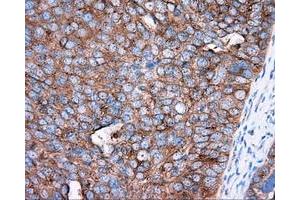 Immunohistochemical staining of paraffin-embedded Adenocarcinoma of colon tissue using anti-PRKAR2A mouse monoclonal antibody. (PRKAR2A anticorps)
