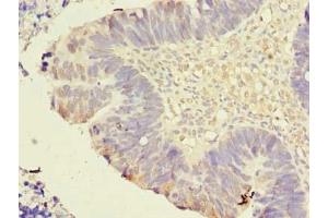 Immunohistochemistry of paraffin-embedded human ovarian cancer using ABIN7173249 at dilution of 1:100