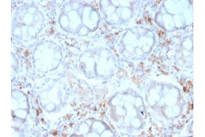 Formalin-fixed, paraffin-embedded human Colon Carcinoma stained with CD209 Mouse Monoclonal Antibody (rC209/1781). (Recombinant DC-SIGN/CD209 anticorps)