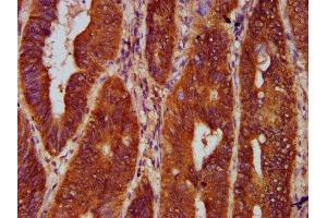 IHC image of ABIN7153815 diluted at 1:300 and staining in paraffin-embedded human colon cancer performed on a Leica BondTM system.