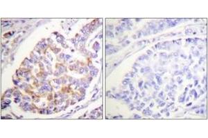 Immunohistochemistry analysis of paraffin-embedded human breast carcinoma, using ADD1 (Phospho-Ser726) Antibody. (alpha Adducin anticorps  (pSer726))