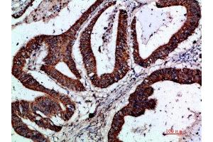 Immunohistochemical analysis of paraffin-embedded human-colon-cancer, antibody was diluted at 1:200 (GREM2 anticorps  (AA 71-120))