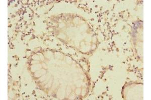 Immunohistochemistry of paraffin-embedded human colon cancer using ABIN7172807 at dilution of 1:100