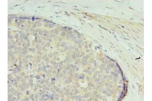 Immunohistochemistry of paraffin-embedded human gastric cancer using ABIN7166707 at dilution of 1:100 (GTPBP6 anticorps  (AA 146-295))