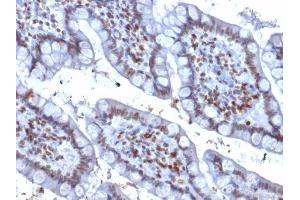 Formalin-fixed, paraffin-embedded human Colon Carcinoma stained with PU.