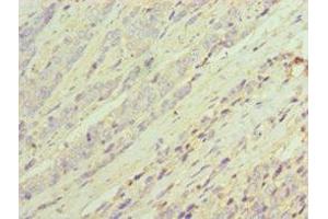 Immunohistochemistry of paraffin-embedded human colon cancer using ABIN7143694 at dilution of 1:100 (AKR1C3 anticorps  (AA 1-323))