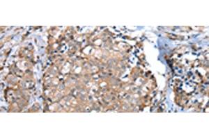 Immunohistochemistry of paraffin-embedded Human breast cancer tissue using WFDC5 Polyclonal Antibody at dilution of 1:60(x200) (WFDC5 anticorps)