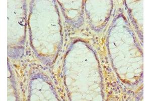 Immunohistochemistry of paraffin-embedded human colon cancer using ABIN7163806 at dilution of 1:100