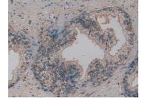 IHC-P analysis of Human Prostate Gland Cancer Tissue, with DAB staining. (Osteopontin anticorps  (AA 17-287))