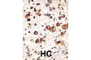 Formalin-fixed and paraffin-embedded human hepatocellular carcinoma tissue reacted with GJB3 polyclonal antibody  , which was peroxidase-conjugated to the secondary antibody, followed by DAB staining.