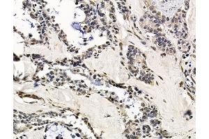 ABIN7096386 and ABIN7100450 at 1/100 staining human ovarian cancer by IHC-P. (C20orf4 anticorps)