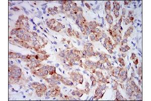 Immunohistochemical analysis of paraffin-embedded prostate cancer tissues using CD10 mouse mAb with DAB staining.