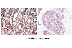 Paraffin embedded sections of human colon canitrocelluloseer tissue were initrocelluloseubated with anti-human ACOT11 (1:100) for 2 hours at room temperature.