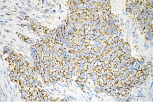 Immunohistochemistry was performed on paraffin-embedded human breast carcinoma using ATP5B antibody (ABIN7797681), 1:200).