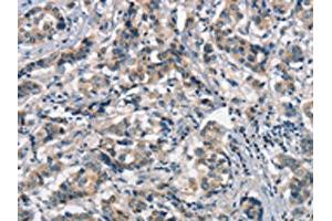 The image on the left is immunohistochemistry of paraffin-embedded Human breast cancer tissue using ABIN7189845(APOA1BP Antibody) at dilution 1/15, on the right is treated with synthetic peptide. (APOA1BP anticorps)