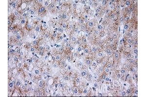 Immunohistochemical staining of paraffin-embedded Carcinoma of Human liver tissue using anti-RAB17 mouse monoclonal antibody. (RAB17 anticorps)