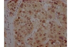 IHC image of ABIN7127369 diluted at 1:100 and staining in paraffin-embedded human liver cancer performed on a Leica BondTM system.