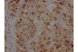 IHC image of ABIN7127369 diluted at 1:100 and staining in paraffin-embedded human liver cancer performed on a Leica BondTM system. (Recombinant BMI1 anticorps)