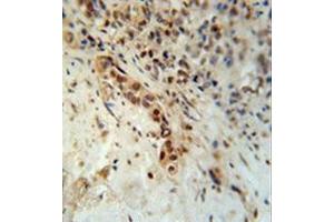 Formalin fixed, paraffin embedded human lung carcinoma stained with Artemis Antibody (N-term) followed by peroxidase conjugation of the secondary antibody and DAB staining. (DCLRE1C anticorps  (N-Term))