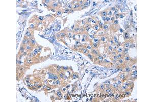 Immunohistochemistry of Human colon cancer using IBSP Polyclonal Antibody at dilution of 1:50 (IBSP anticorps)