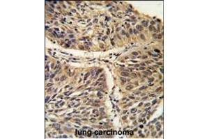 Formalin-fixed and paraffin-embedded human lung carcinoma reacted with CCT3 Antibody (C-term), which was peroxidase-conjugated to the secondary antibody, followed by DAB staining. (CCT3 anticorps  (C-Term))