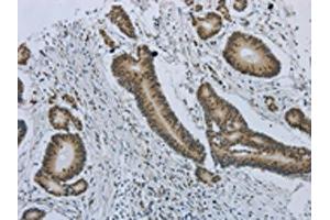 The image on the left is immunohistochemistry of paraffin-embedded Human colorectal cancer tissue using ABIN7191486(MMP24 Antibody) at dilution 1/25, on the right is treated with synthetic peptide. (MMP24 anticorps)