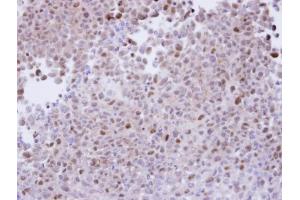 IHC-P Image Immunohistochemical analysis of paraffin-embedded CL1-5 xenograft, using proteasome alpha 7, antibody at 1:100 dilution. (PSMA7 anticorps  (Center))