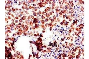 Immunohistochemistry of paraffin-embedded human lung cancer using ABIN7144520 at dilution of 1:100