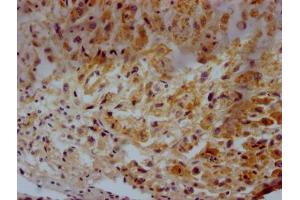 IHC image of ABIN7147174 diluted at 1:500 and staining in paraffin-embedded human glioma tissue performed on a Leica BondTM system. (CD63 anticorps  (AA 103-203))