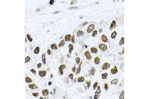 Immunohistochemical analysis of METTL3 staining in human lung cancer formalin fixed paraffin embedded tissue section. (METTL3 anticorps)