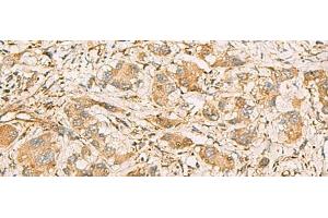 Immunohistochemistry of paraffin-embedded Human liver cancer tissue using MRPS35 Polyclonal Antibody at dilution of 1:60(x200)